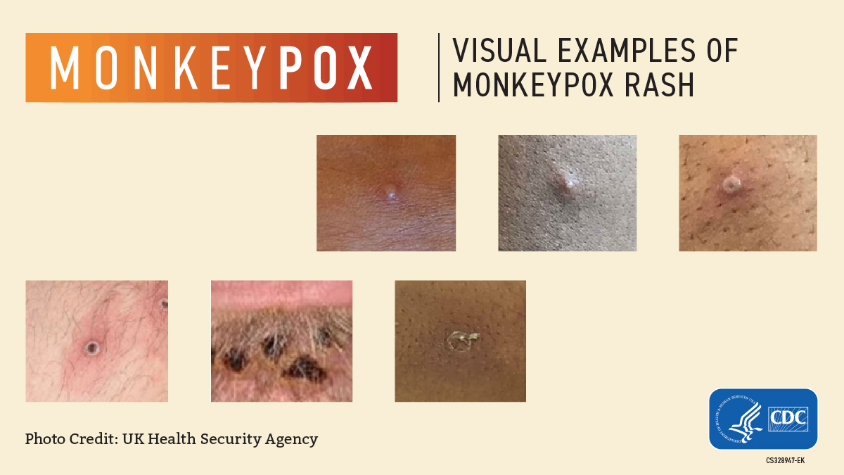 Monkeypox lesions 